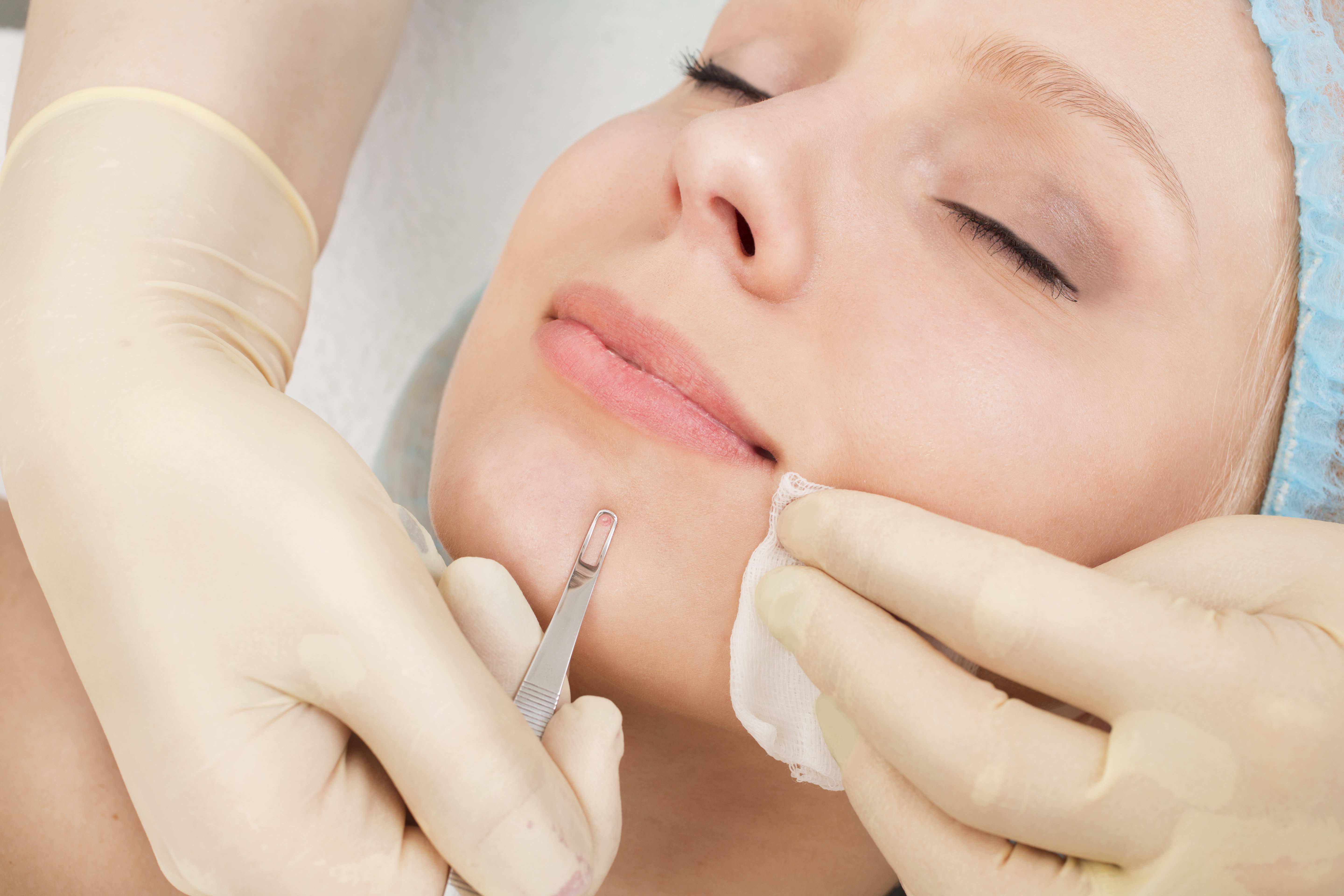 extraction facial