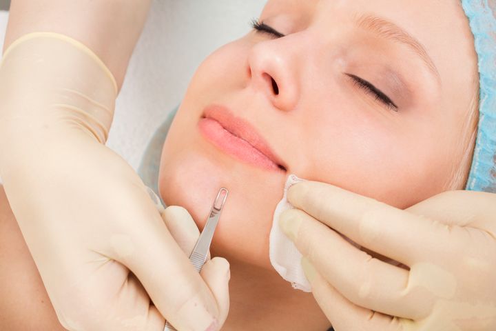 Are Blackhead Extractions Good For Our Skin Or Not Huffpost Life