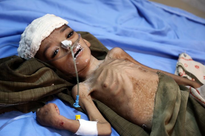 A malnourished Yemeni child awaits treatment at a hospital in the Yemeni port city of Hodeidah