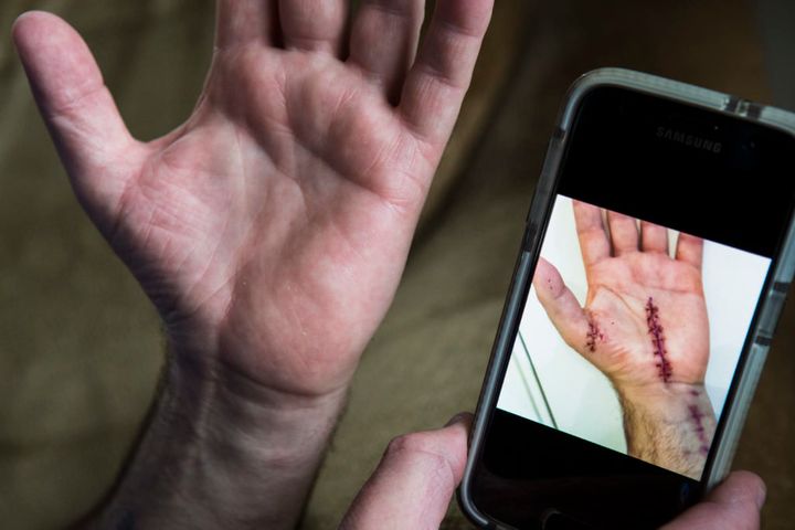 Mark Eberley shows his scar from surgery after carpal tunnel syndrome left him unable to continue work at the Tesla factory in Fremont, California. He has been out of work for years. 