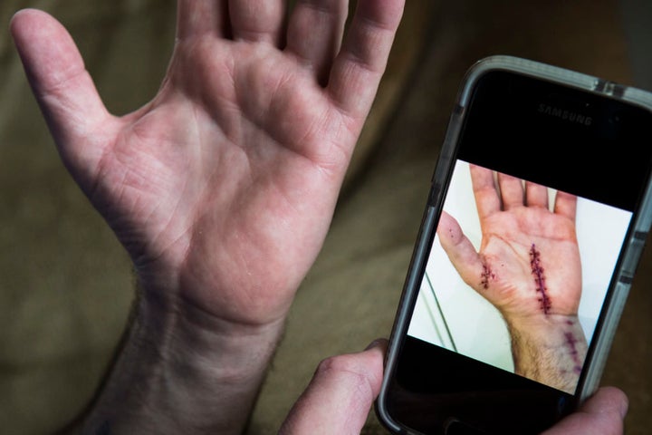 Mark Eberley shows his scar from surgery after carpal tunnel syndrome left him unable to continue work at the Tesla factory in Fremont, California. He has been out of work for years.