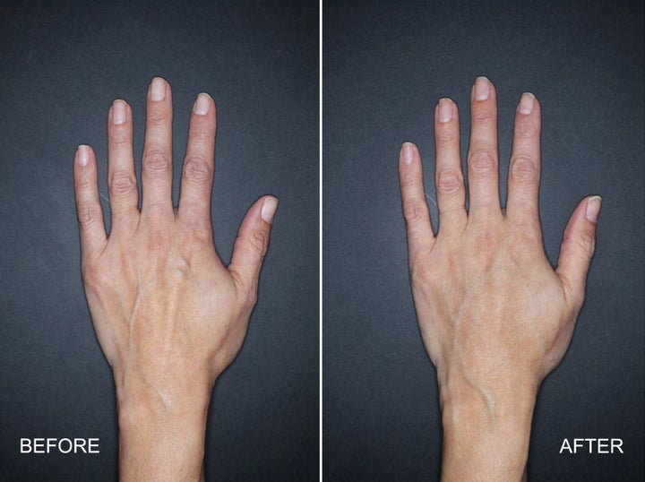 A patient's hand seen before (left) treatment and four weeks after being injected with Restylane Lyft.