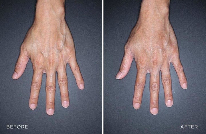 On the left, a patient's hand before being treated with filler and, on the right, her hand after treatment.