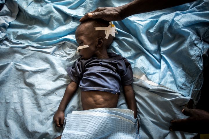 Katumbuma, 2 years old is treated for malnourishment in a UNICEF supported hospital in the Kasai Province, Democratic Republic of Congo.