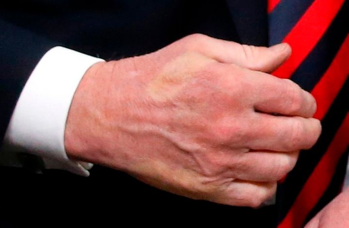 The imprint of Macron's thumb can be seen across the back of Trump's hand after they shook hands.