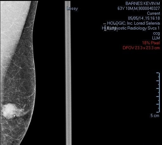 Khevin's mammogram from May 2014.