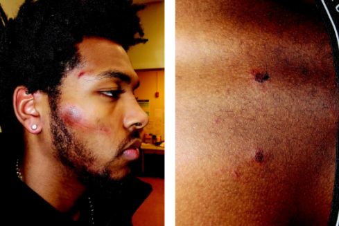 Photos taken after Sterling Brown's arrest show abrasions to his face and puncture wounds to his back.