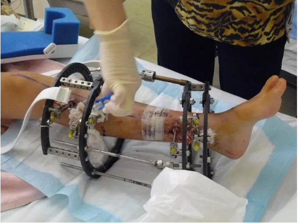 <p>Miranda’s leg, after many surgeries</p>