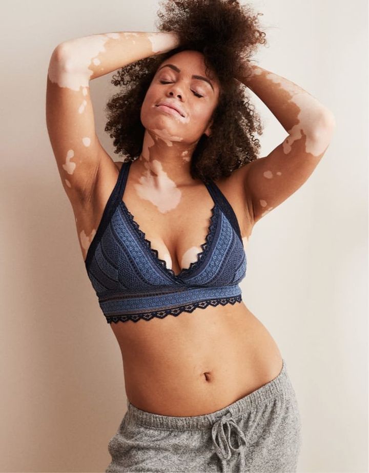 A model with vitiligo is photographed in an Aerie bra.