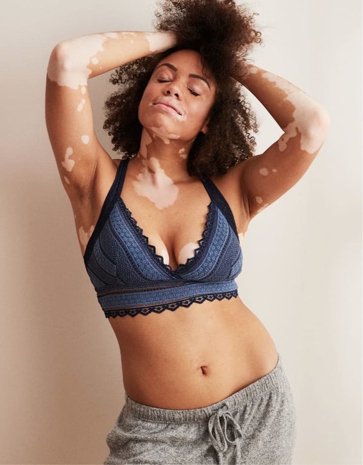 American lingerie brand Aerie takes inclusivity to new level; features  models with medical conditions