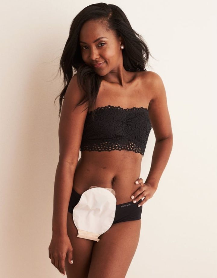 A lingerie model with an ostomy pouch.