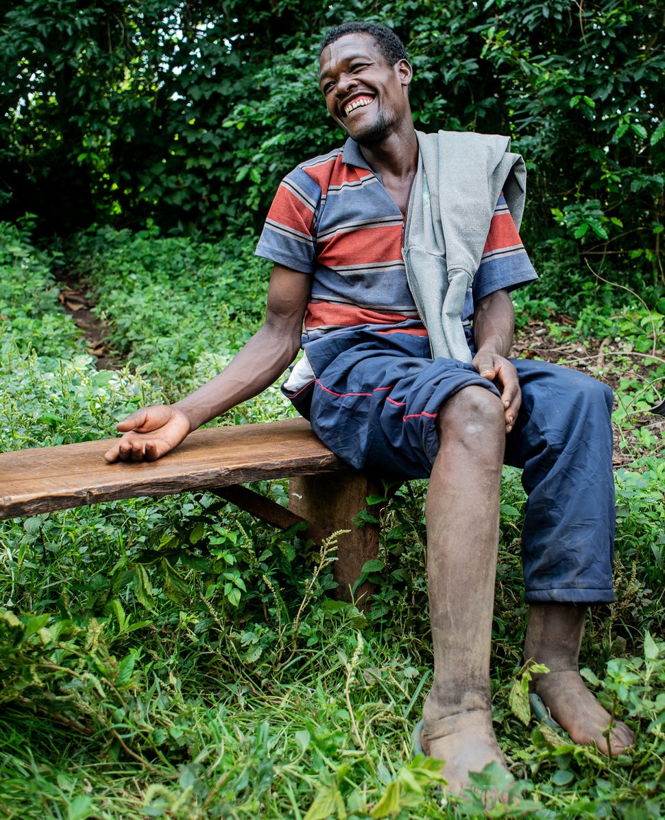 Tesfaye Bezabh in the village of Gesabale in southern Ethiopia has mild podoconiosis and says he rarely wears shoes.