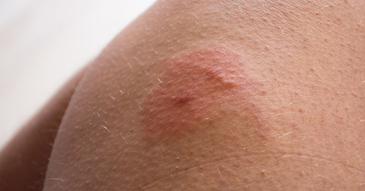 how-to-treat-insect-bites-as-nhs-helpline-reports-spike-in-calls