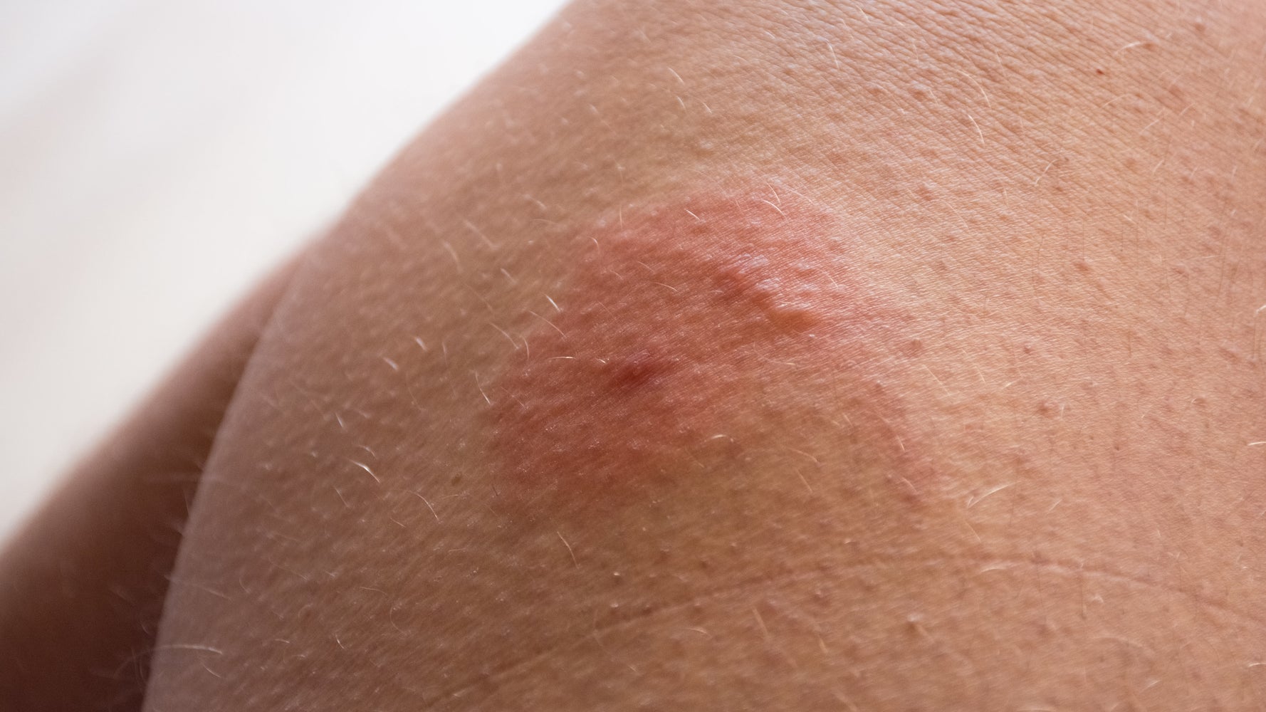 How To Prevent Insect Bites Naturally Nhs