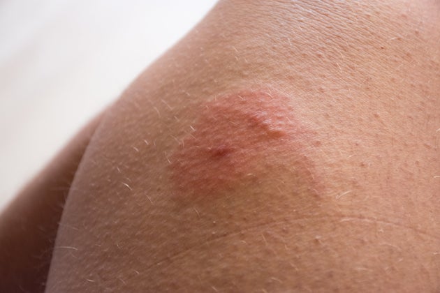 How To Treat Insect Bites As Nhs Helpline Reports Spike In Calls