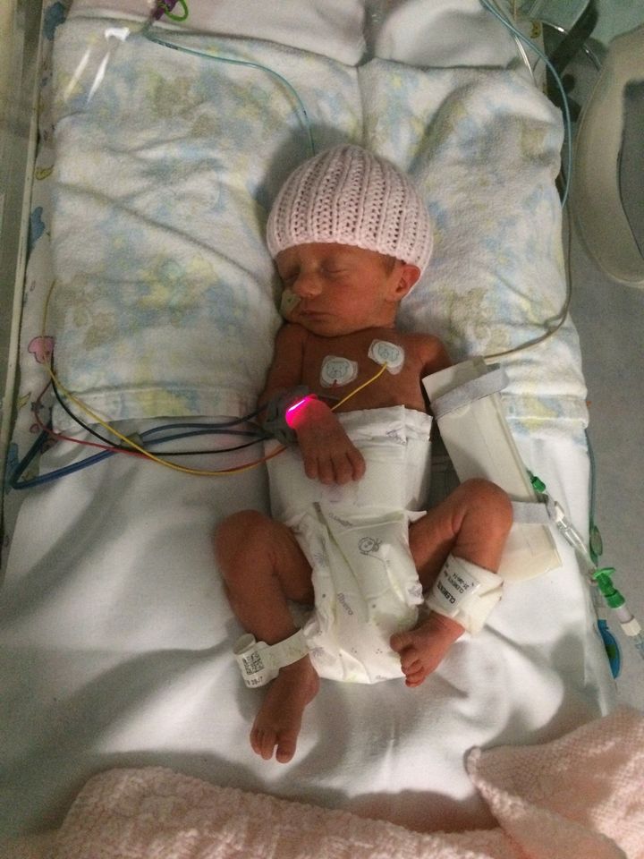Isabelle in the NICU. Her mum suffered flashbacks to this time when she returned to work and was diagnosed with PTSD.