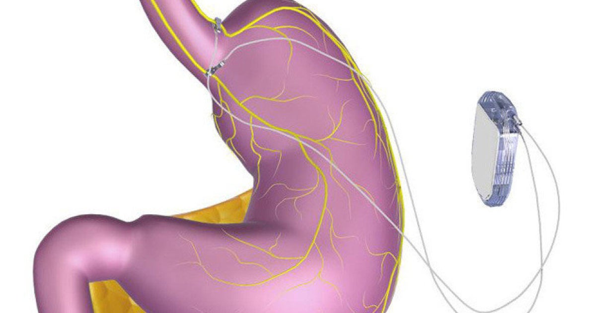 FDA Approves Appetite-Curbing Pacemaker | HuffPost Videos