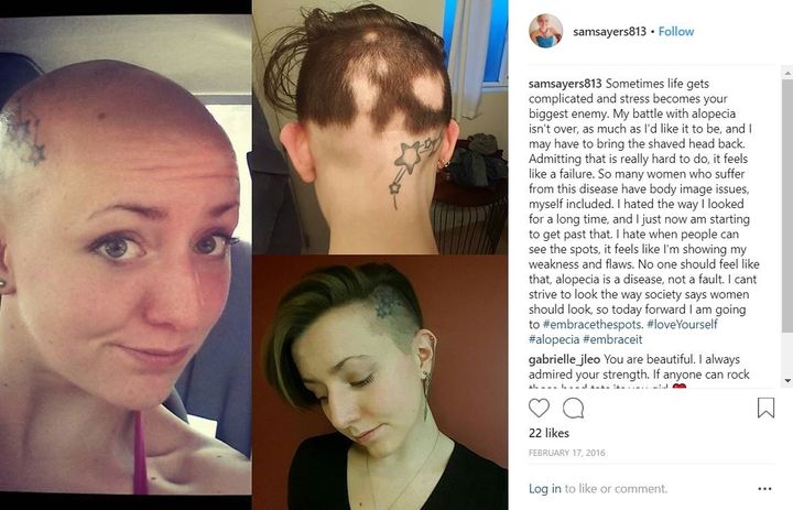 Samantha Sayers grew up in Girard, Pennsylvania, a small borough in the Erie metropolitan statistical area. In high school, she was diagnosed with alopecia, an incurable autoimmune disorder that attacks hair follicles, causing hair to fall out.