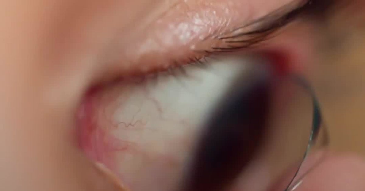 Doctor Finds Contact Lens Stuck In Woman's Eyelid 28 Years After She ...