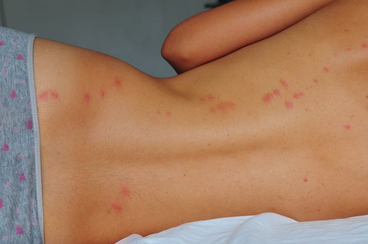 Bed bug bites appear as blotchy red dots on the skin (file photo).