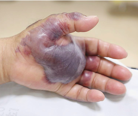 A photo of the patient's left hand from the New England Journal of Medicine.