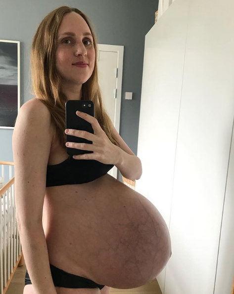 Grossesse : enceinte de triplés, un ventre impressionnant