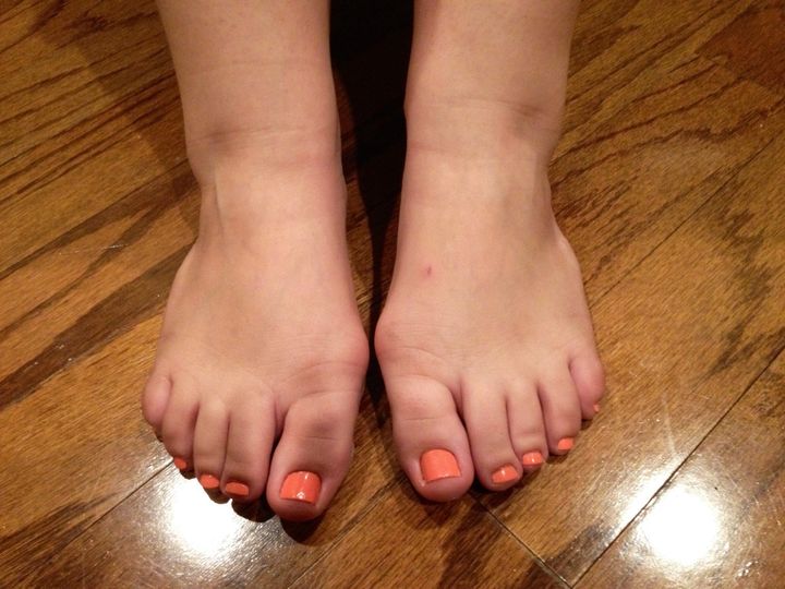 Heels in asian feet 