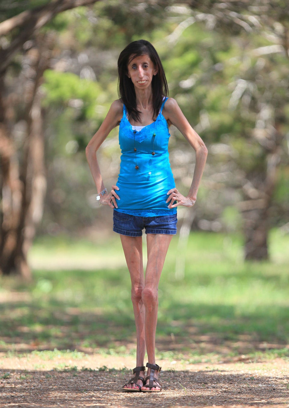 Lizzie Velasquez, Woman Born Without Adipose Tissue