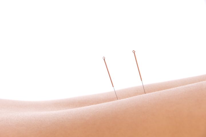 woman getting an acupuncture...
