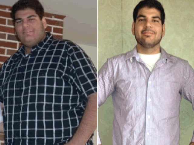 Mike's Story, Weight Loss Patient Stories