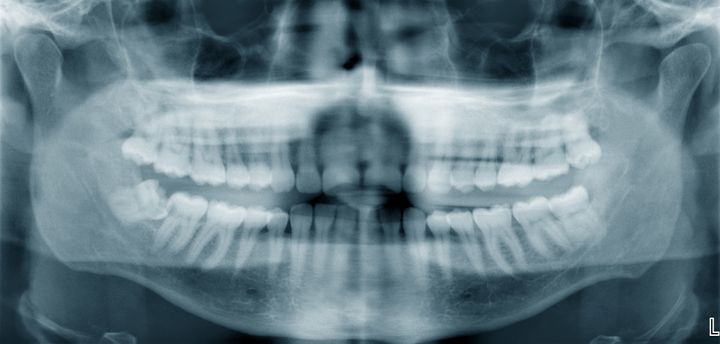 panoramic dental x ray.