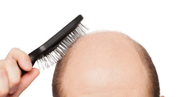 human alopecia or hair loss ...