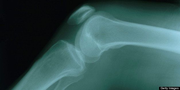 X-ray of the normal left knee of a 58-year-old female.