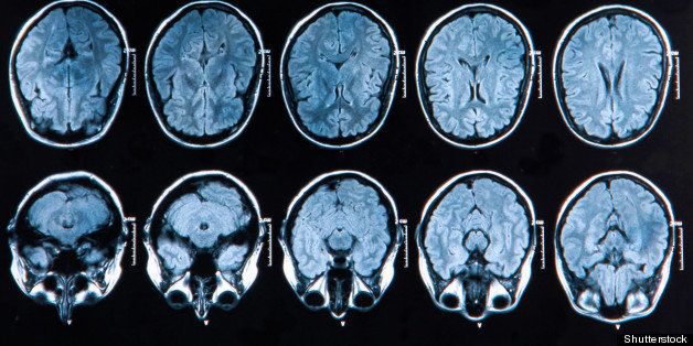 mri scan of the human brain