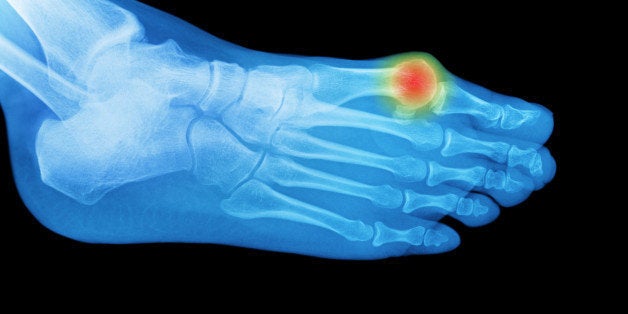 What to Do about Bunions - Harvard Health Publishing - Harvard Health