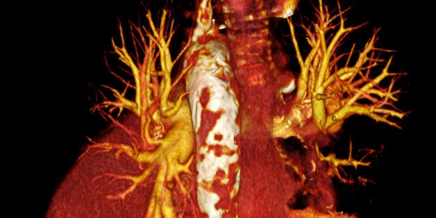 3-dimensional CT scan of a posterior view of the heart of a 50 year old woman showing extensive calcification (shown in white) of the arch of the aorta and the descending aorta.