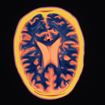 1. Multiple Sclerosis