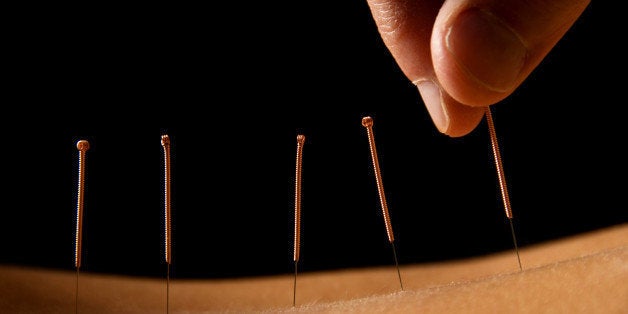 woman getting an acupuncture...