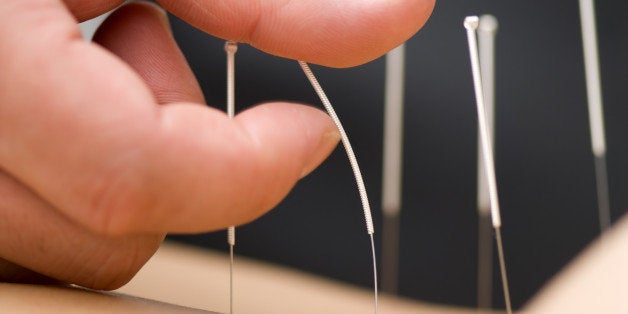 acupuncture