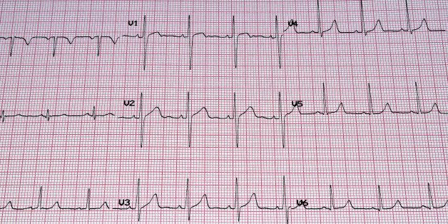 heart analysis ecg graph.