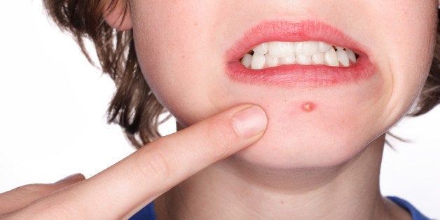 So You Have A Pimple Here S How To Get Rid Of It Huffpost Life