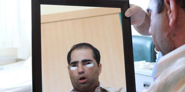 ANTALYA, TURKEY NOVEMBER 13 : Turkish patient Salih Ustun is seen after having had his beard shaved off on November 13, 2013 in Antalya, Turkey. Salih Ustun had his face transplant surgery on August 23,2013 in Turkey which was the Turkey's 6th face transplant surgery. (Photo by Akdeniz University/Anadolu Agency/Getty Images)