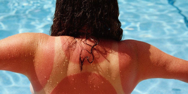 10 Tips For Treating A Bad Sunburn Huffpost Life