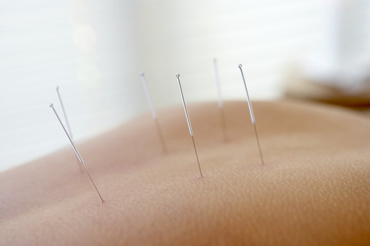 Can Acupuncture Treatment Help Cancer Patients?