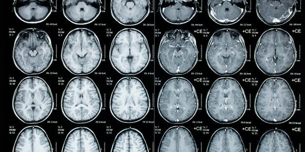 Normal Cat Scan image of a child cranium