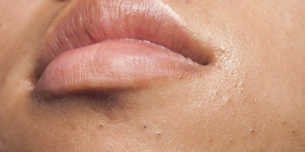 Black heads under the lips area of a teenager