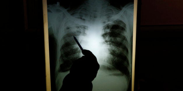 In this Monday, Feb. 3, 2014 photo, senior chest physician Dr. A.K. Upadhaya looks at x-ray results of patient Shyam Lal, suspected to have tuberculosis (TB), at Lal Bahadur Shastri Government Hospital at Ram Nagar in Varanasi, India. India has the highest incidence of TB in the world, according to the World Health Organization's Global Tuberculosis Report 2013, with as many as 2.4 million cases. India saw the greatest increase in multidrug-resistant TB between 2011 and 2012. The disease kills about 300,000 people every year in the country. (AP Photo/Rajesh Kumar Singh)