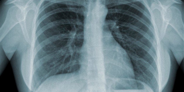 Detail of an x-ray of lungs on black background