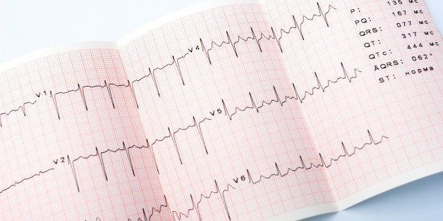 electrocardiogram waveform...