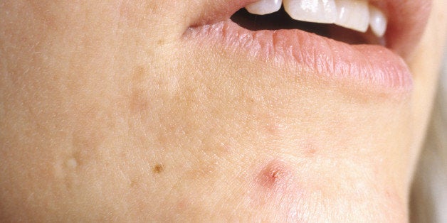 cystic acne pop